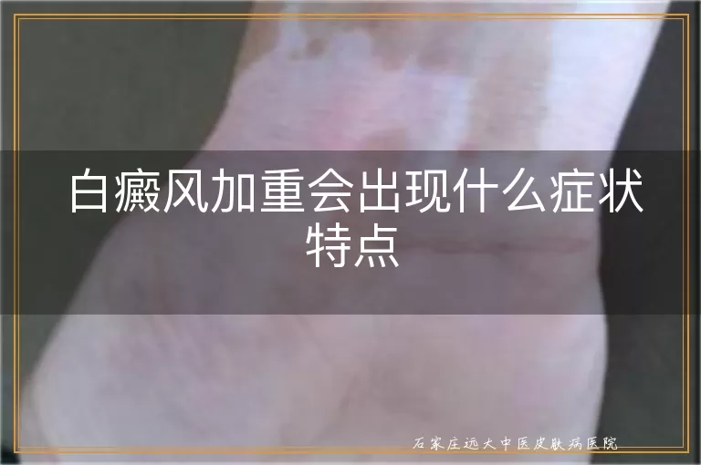 白癜风加重会出现什么症状特点