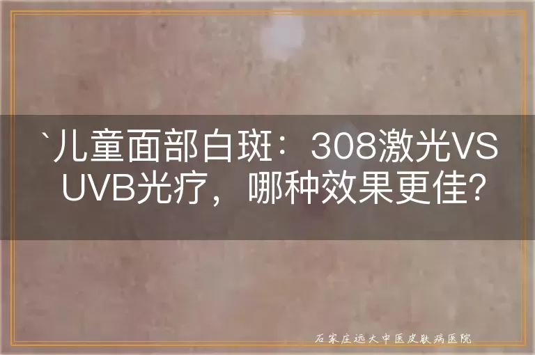 儿童面部白斑：308激光VS UVB光疗，哪种效果更佳？