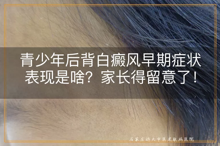 青少年后背白癜风早期症状表现是啥？家长得留意了！