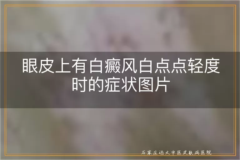 眼皮上有白癜风白点点轻度时的症状图片