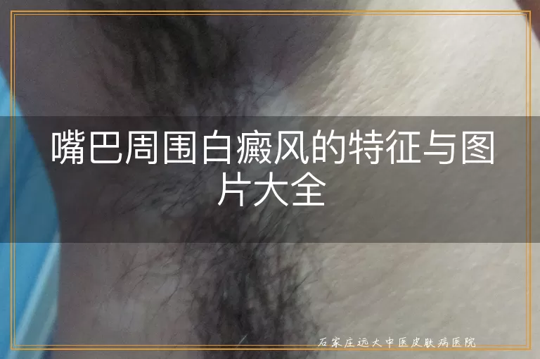 嘴巴周围白癜风的特征与图片大全