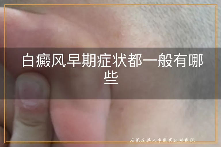 白癜风早期症状都一般有哪些