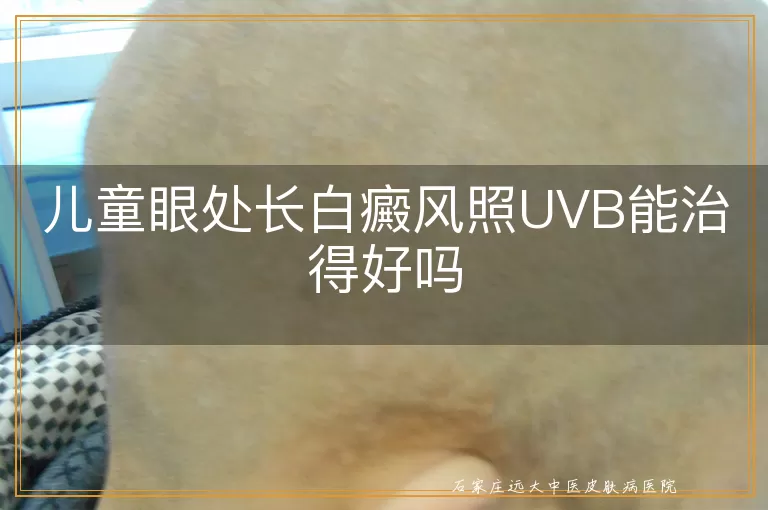 儿童眼处长白癜风照UVB能治得好吗