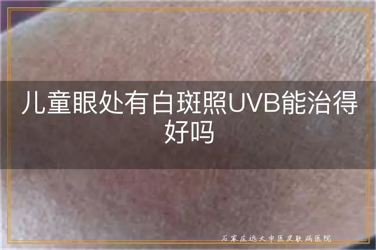 儿童眼处有白斑照UVB能治得好吗