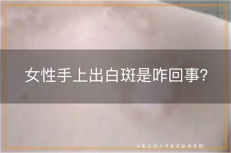 女性手上出白斑是咋回事？