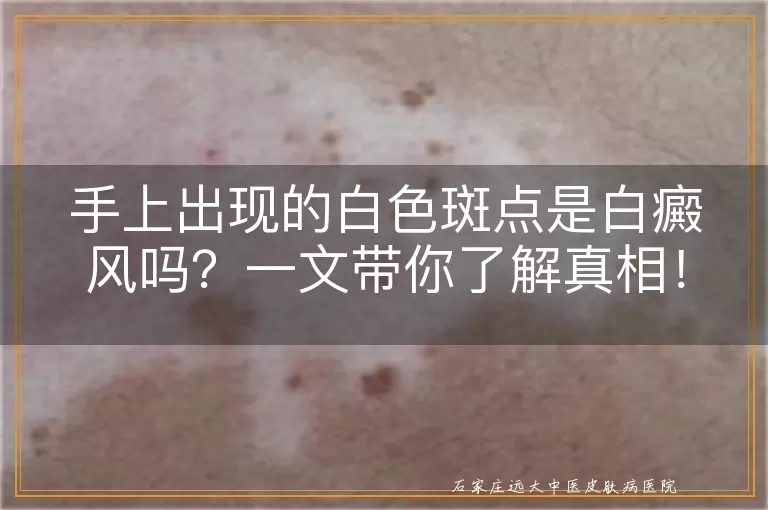 手上出现的白色斑点是白癜风吗？一文带你了解真相！