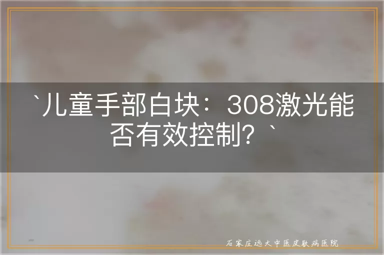 儿童手部白块：308激光能否有效控制？