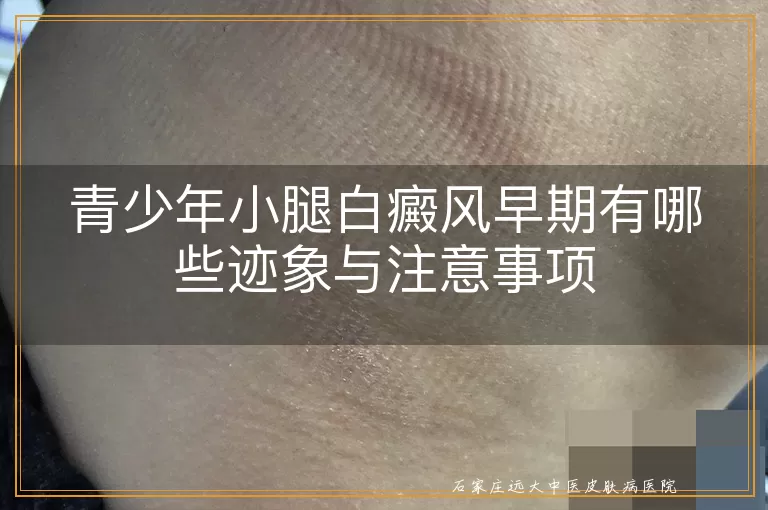 青少年小腿白癜风早期有哪些迹象与注意事项