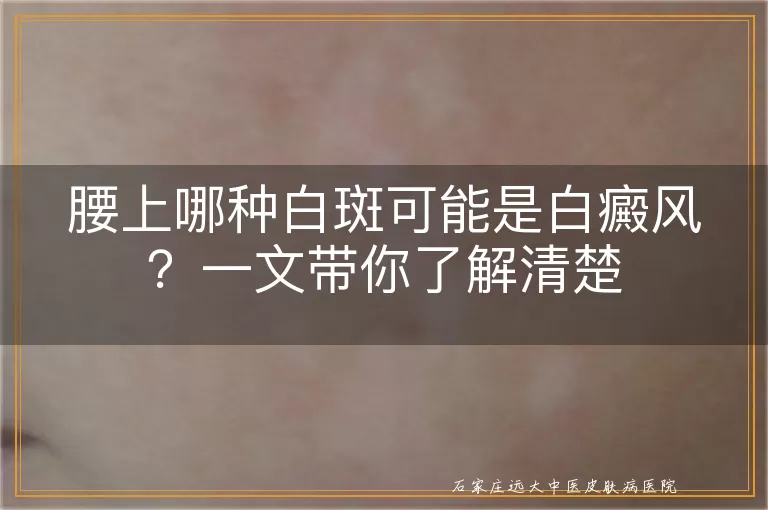 腰上哪种白斑可能是白癜风？一文带你了解清楚