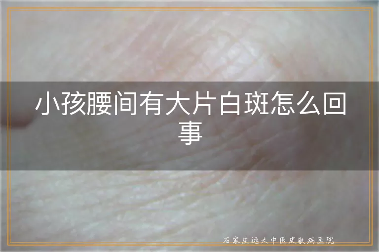 小孩腰间有大片白斑怎么回事