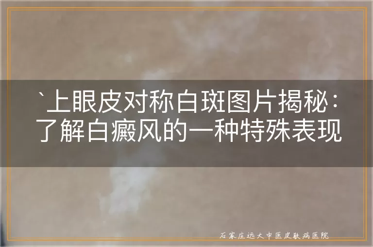 上眼皮对称白斑图片揭秘：了解白癜风的一种特殊表现