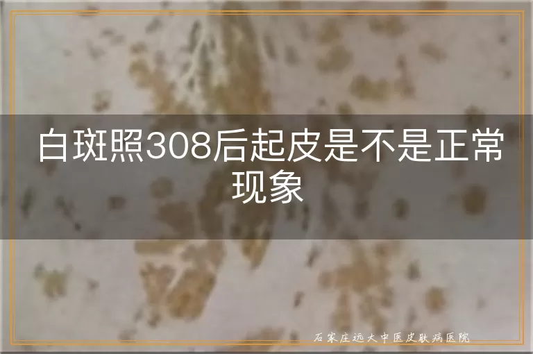 白斑照308后起皮是不是正常现象