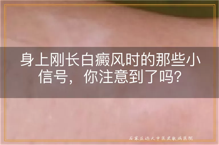 身上刚长白癜风时的那些小信号，你注意到了吗？