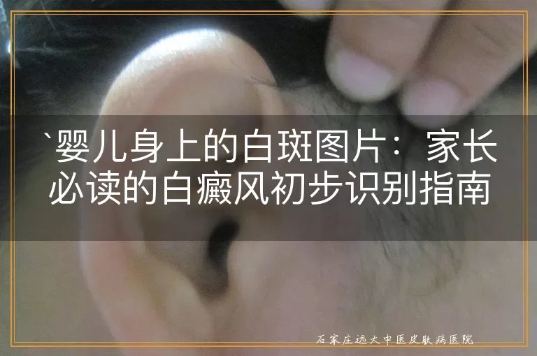 婴儿身上的白斑图片：家长必读的白癜风初步识别指南