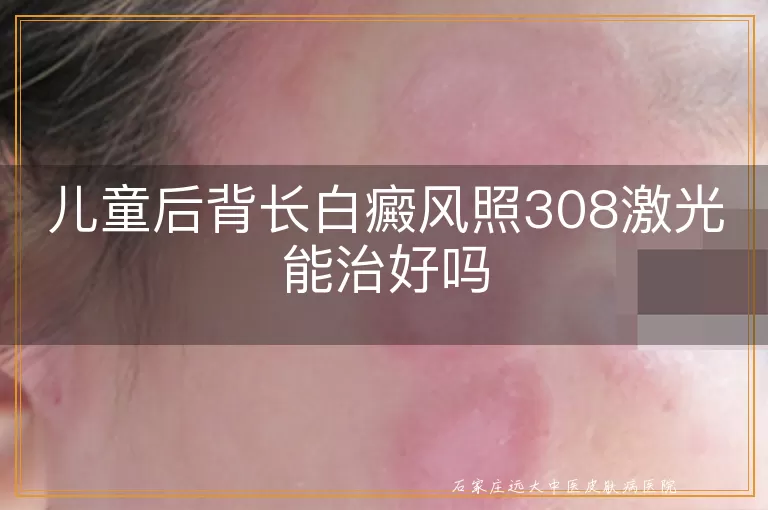 儿童后背长白癜风照308激光能治好吗