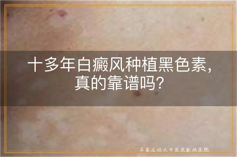 十多年白癜风种植黑色素，真的靠谱吗？