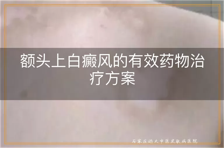 额头上白癜风的有效药物治疗方案