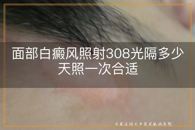 面部白癜风照射308光隔多少天照一次合适