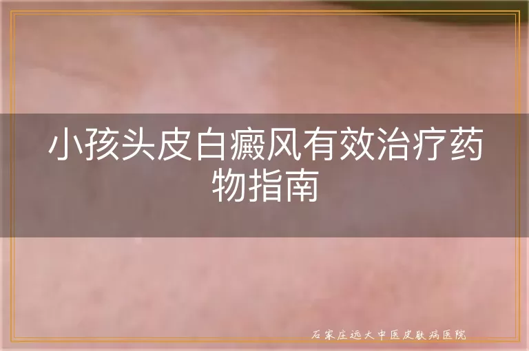 小孩头皮白癜风有效治疗药物指南