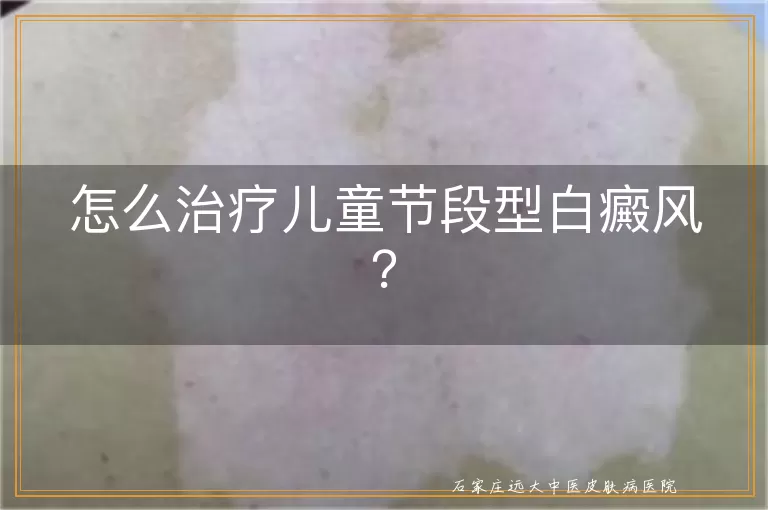 怎么治疗儿童节段型白癜风？