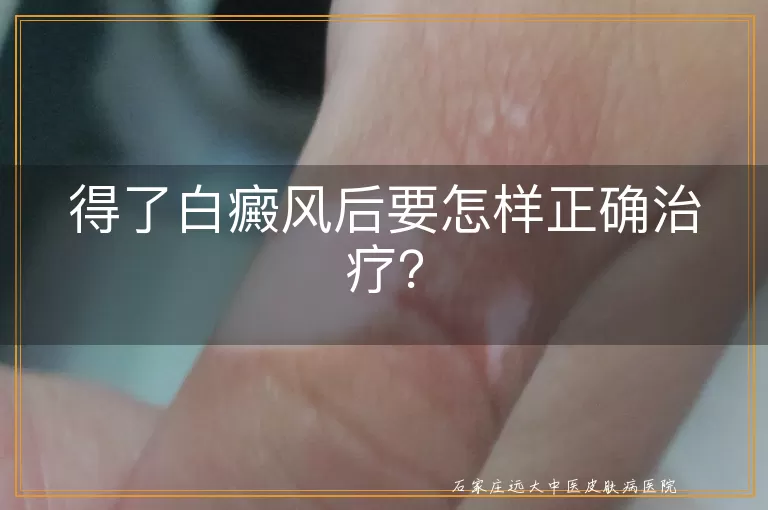 得了白癜风后要怎样正确治疗？