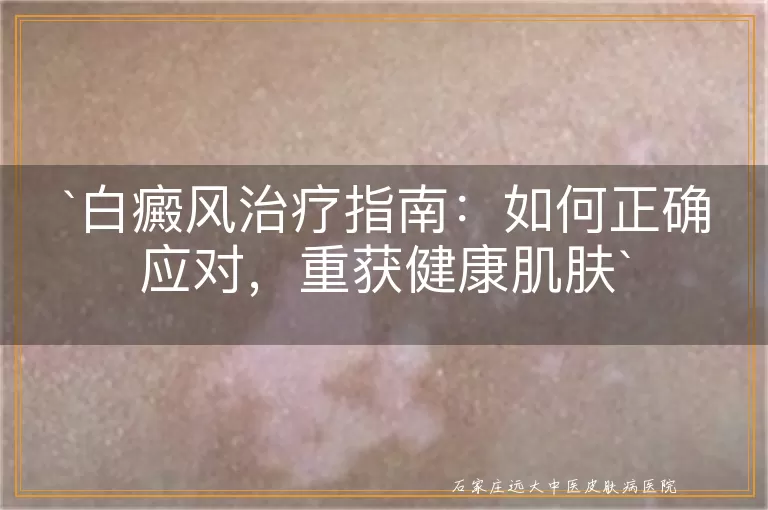 白癜风治疗指南：如何正确应对，重获健康肌肤