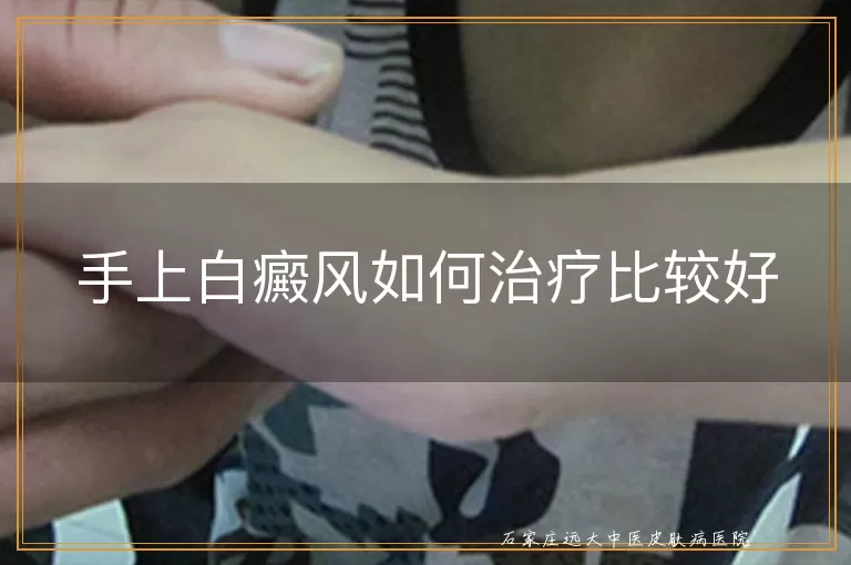 手上白癜风如何治疗比较好