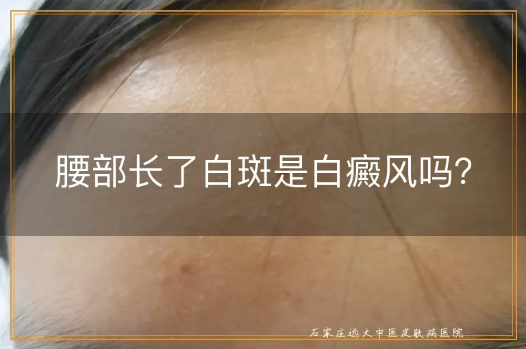 腰部长了白斑是白癜风吗？