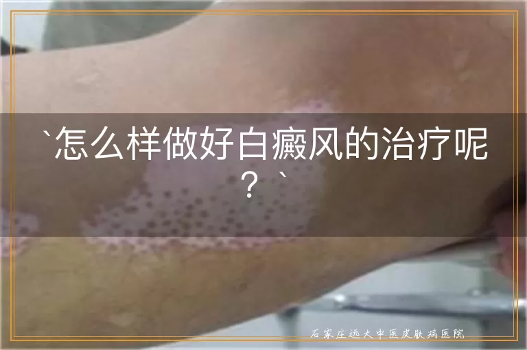 怎么样做好白癜风的治疗呢？