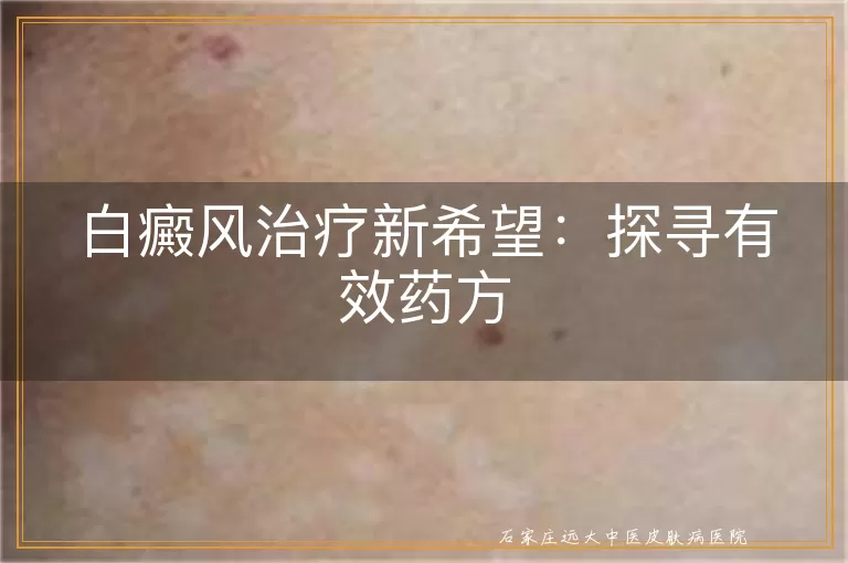 白癜风治疗新希望：探寻有效药方