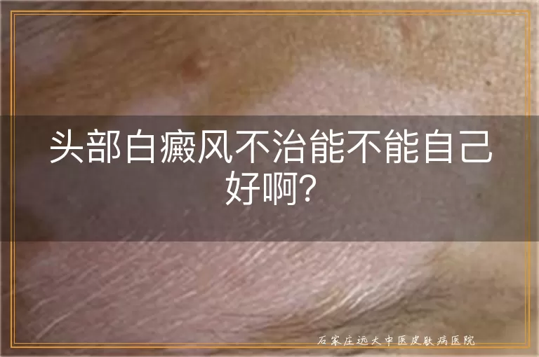 头部白癜风不治能不能自己好啊？