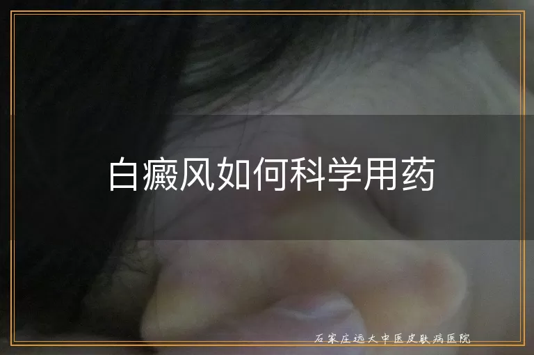 白癜风如何科学用药