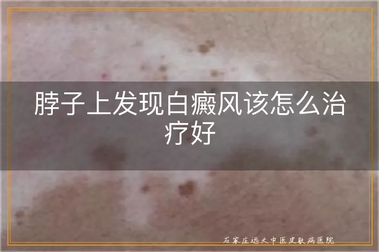 脖子上发现白癜风该怎么治疗好