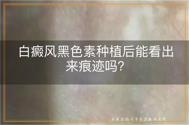 白癜风黑色素种植后能看出来痕迹吗？