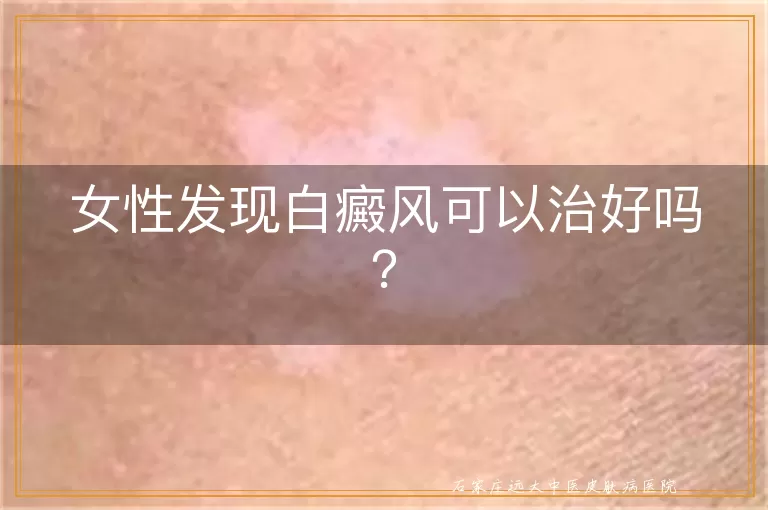 女性发现白癜风可以治好吗？