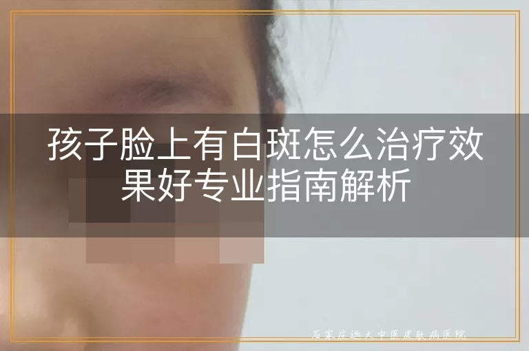 孩子脸上有白斑怎么治疗效果好专业指南解析