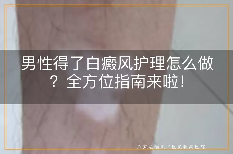 男性得了白癜风护理怎么做？全方位指南来啦！