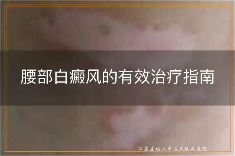 腰部白癜风的有效治疗指南