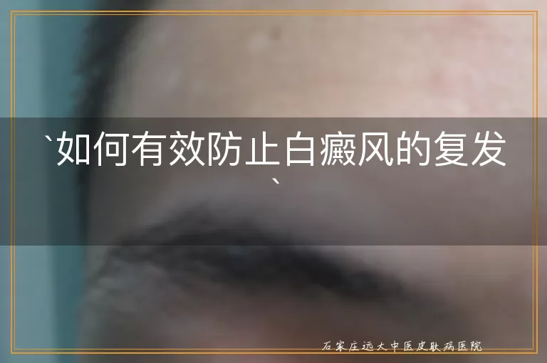 如何有效防止白癜风的复发