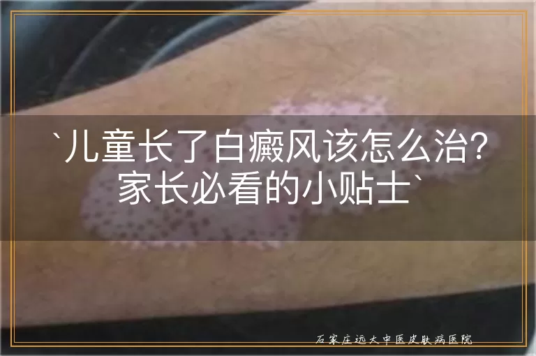 儿童长了白癜风该怎么治？家长必看的小贴士