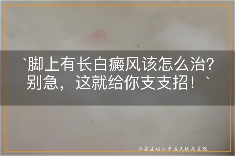 脚上有长白癜风该怎么治？别急，这就给你支支招！