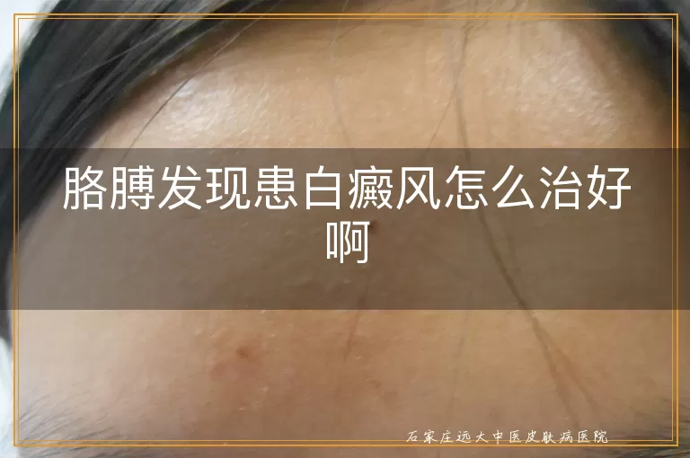 胳膊发现患白癜风怎么治好啊