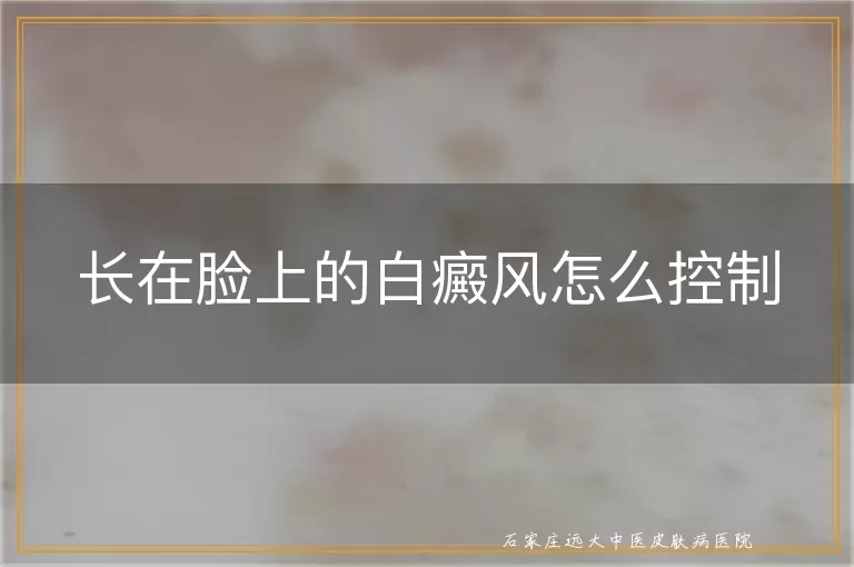 长在脸上的白癜风怎么控制