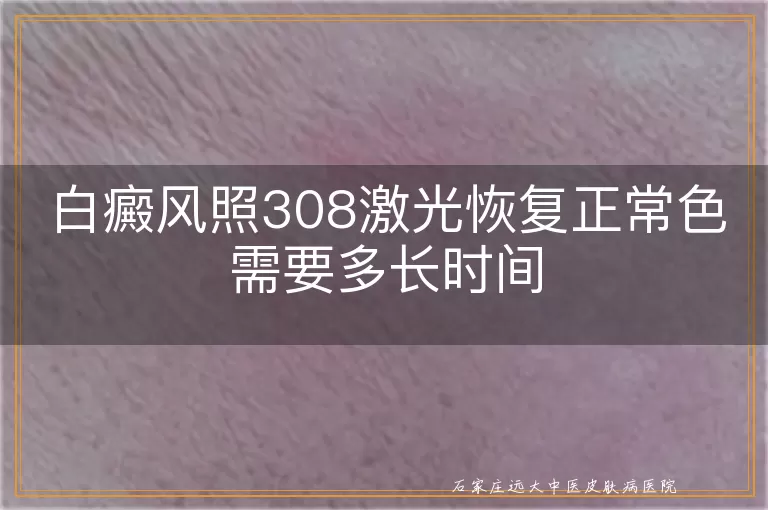 白癜风照308激光恢复正常色需要多长时间