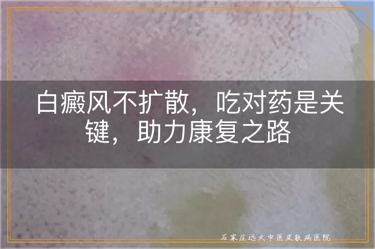 白癜风不扩散，吃对药是关键，助力康复之路