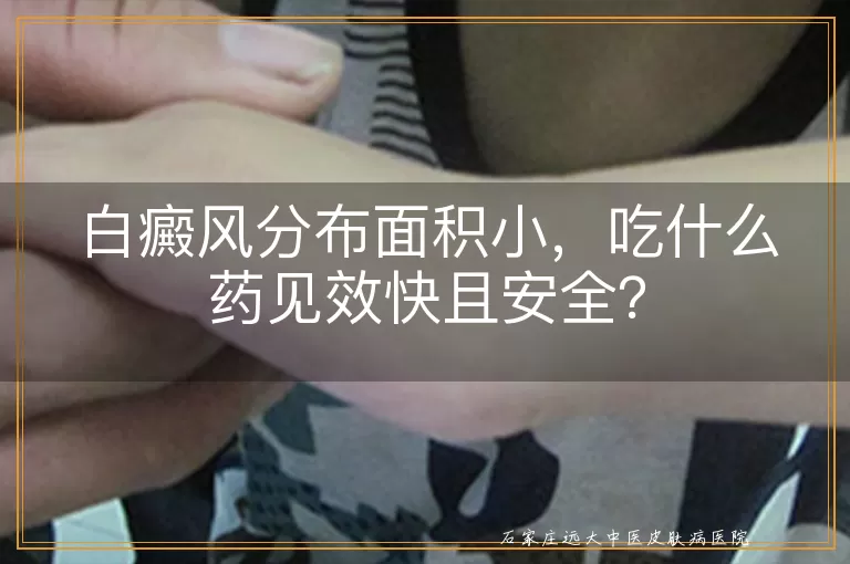 白癜风分布面积小，吃什么药见效快且安全？