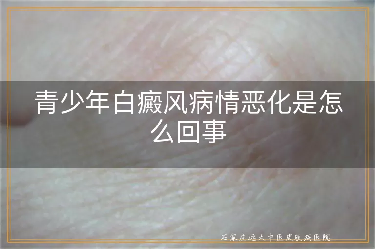 青少年白癜风病情恶化是怎么回事