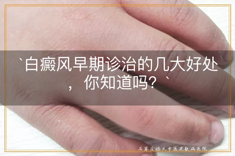 白癜风早期诊治的几大好处，你知道吗？