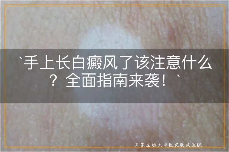 手上长白癜风了该注意什么？全面指南来袭！