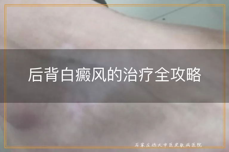 后背白癜风的治疗全攻略